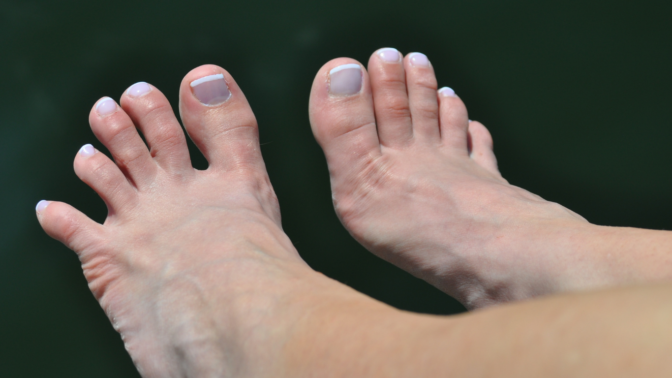 Hammertoes