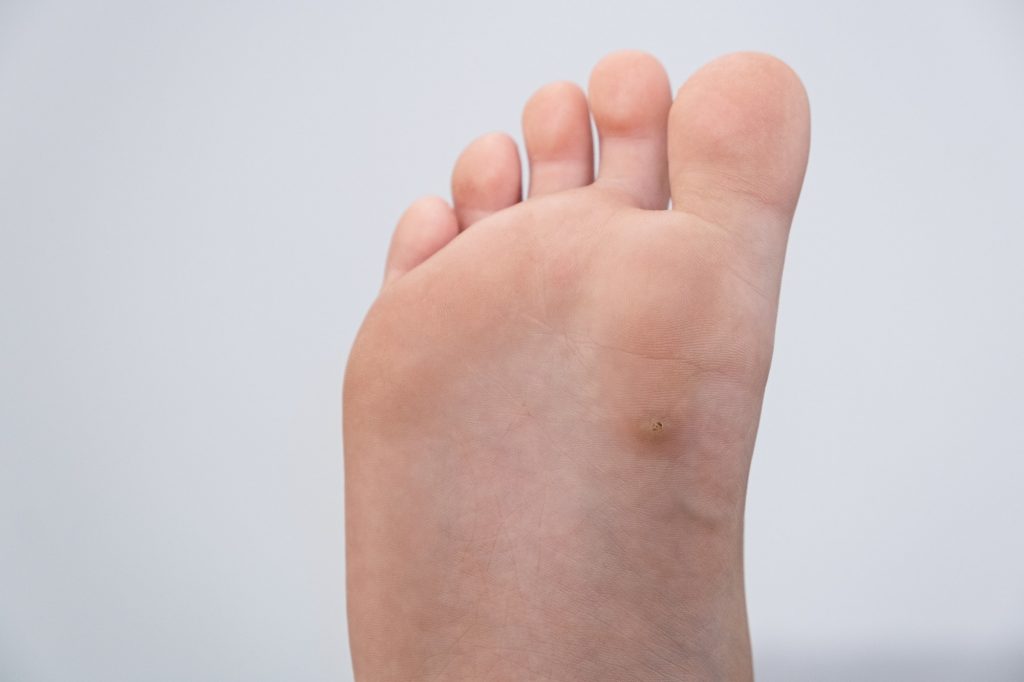 Plantar warts