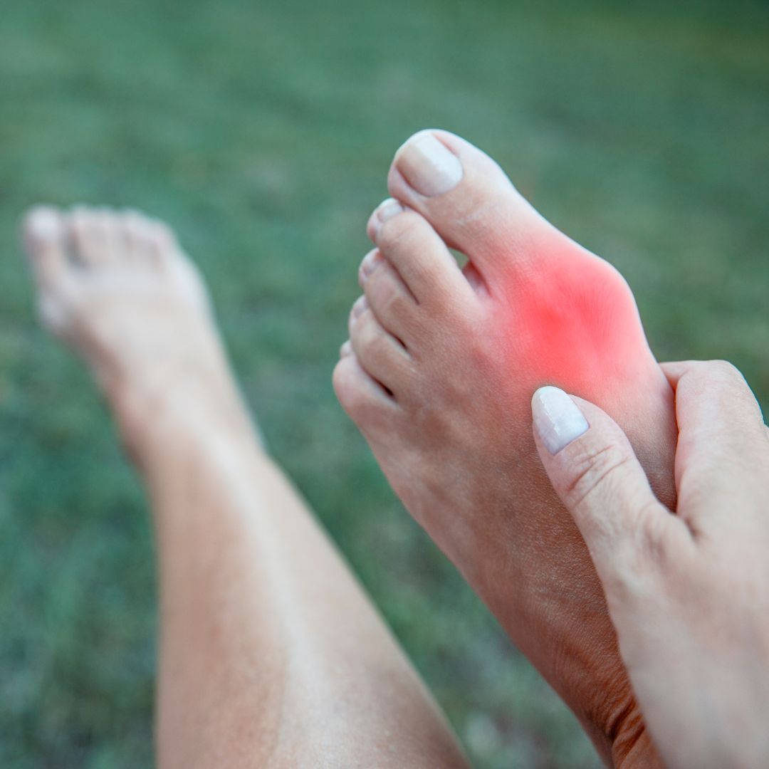 Bunions: Causes, Symptoms, and Modern Treatments Dr. Herbst Podiatry Associates of Florida San Jose